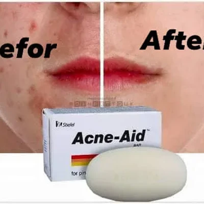Acne Aid Soap (75g)